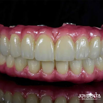 কেনা হালকা ওজনের টাইটানিয়াম ড্যান্টাল মালং হাইব্রিড ব্রিজ দাঁতের পুনরুদ্ধারের জন্য আরামদায়ক অনলাইনে উৎপাদন