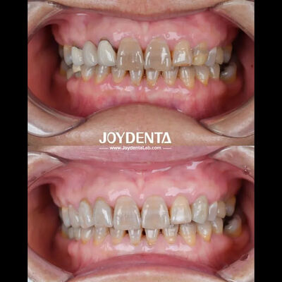 কেনা হালকা দাঁতের জিরকোনিয়া সর্বোত্তম রোগীর অভিজ্ঞতার জন্য প্রাকৃতিক রঙ অনলাইনে উৎপাদন