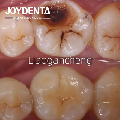 কেনা প্রাপ্তবয়স্ক এবং শিশুদের জন্য পোরসেলান ডেন্টাল ইনলে পুনরুদ্ধারকারী ব্যতিক্রমী কর্মক্ষমতা অনলাইনে উৎপাদন