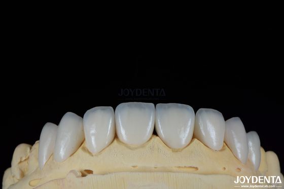 দীর্ঘস্থায়ী এবং দাগ প্রতিরোধী দাঁত veneers সঙ্গে ব্যক্তিগতকৃত ছায়াছবি জন্য প্রাকৃতিক দাঁত