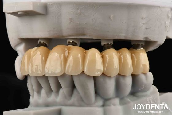 হাড়ের ঘনিষ্ঠ বন্ধু সৌন্দর্যের ভিত্তি জিরকোনিয়া ইমপ্লান্ট কোন ধাতু এলার্জির ঝুঁকি ছাড়াই নান্দনিকভাবে সর্বোচ্চ পছন্দ