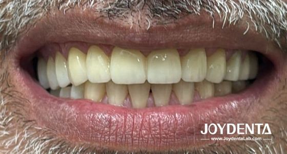 প্রাকৃতিক দাঁতের মতো দেখতে জিরকোনিয়া ডেন্টার