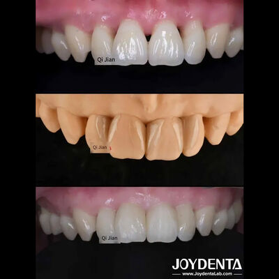 গ্রাসস্কিপটার ফিনিয়ারগুলি প্রাকৃতিক স্বচ্ছতাযুক্ত দাঁতের ফিনিয়ারগুলির জন্য নিখুঁত সমাধান