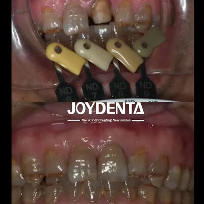 স্বচ্ছতা জিরকোনিয়া মুকুট মাল্টিলেয়ার গ্রেডিয়েন্ট প্রযুক্তি