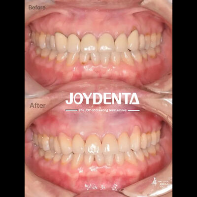 নিরাপদ ওরাল টিস্যু এবং CAD / CAM সামঞ্জস্যের জন্য ডেন্টাল জিরকোনিয়া